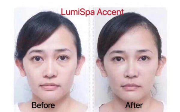 LumiSpa® Accent Bundle Before & After Results