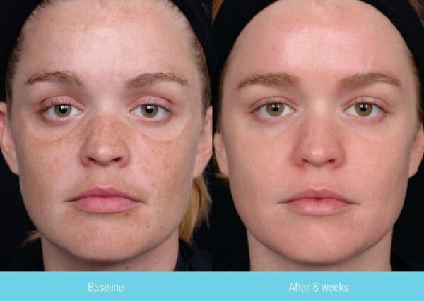 Nuskin 180 Anti-Aging Skin Therapy System before and after